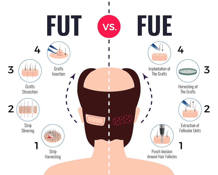 The Guide To Getting A Hair Transplant In South Korea Shin Medical The Guide To Getting A Hair Transplant In South Korea Shin Medical